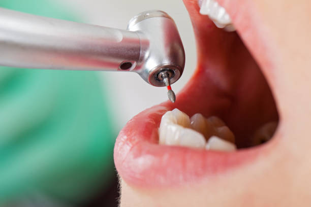 Best Urgent Care for Lost Fillings or Crowns in Solana Beach, CA